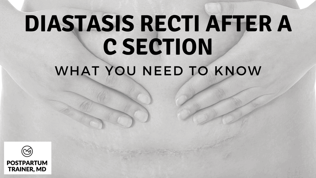 Diastas-recti-after-c-section