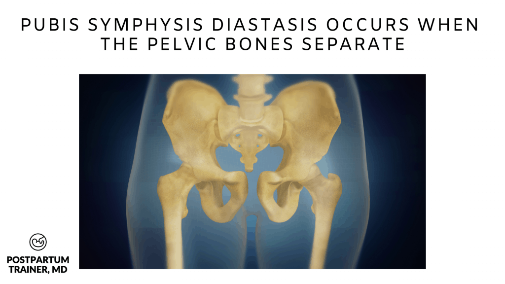 pubis-symphysis-diastasis