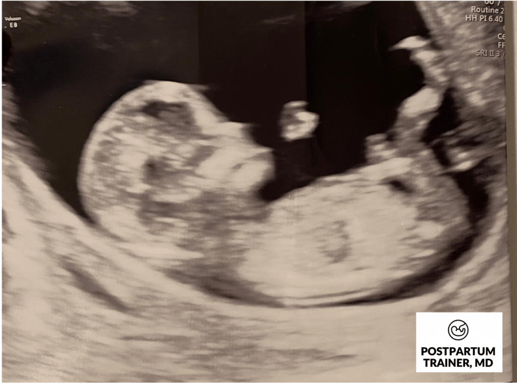 12-week-pregnant-ultrasound