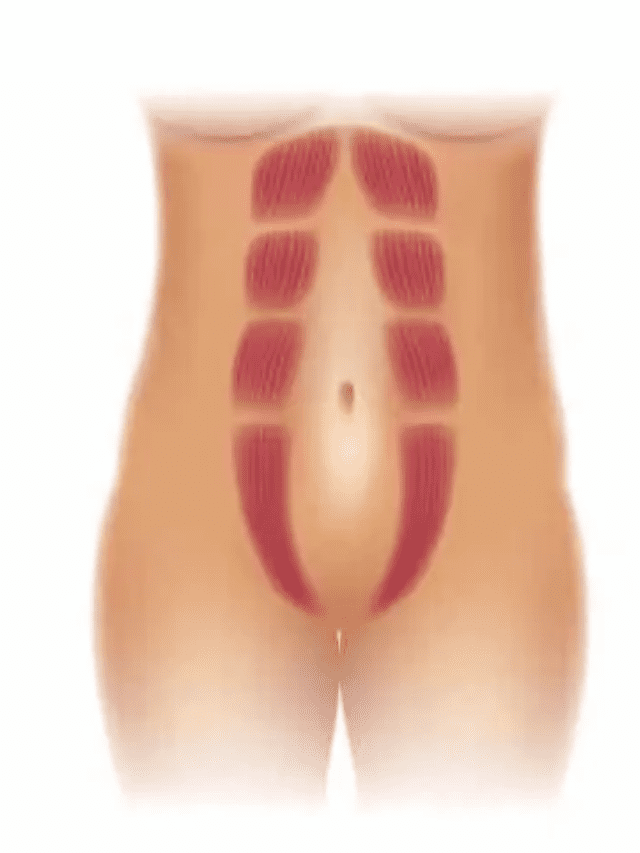 image of rectus abdominis muscles split in the midline